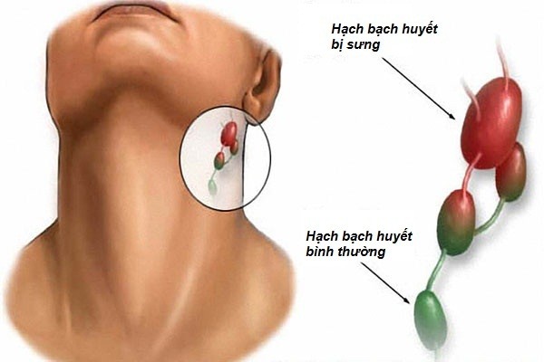 Viêm hạch bạch huyết mãn tính - Hình ảnh minh họa